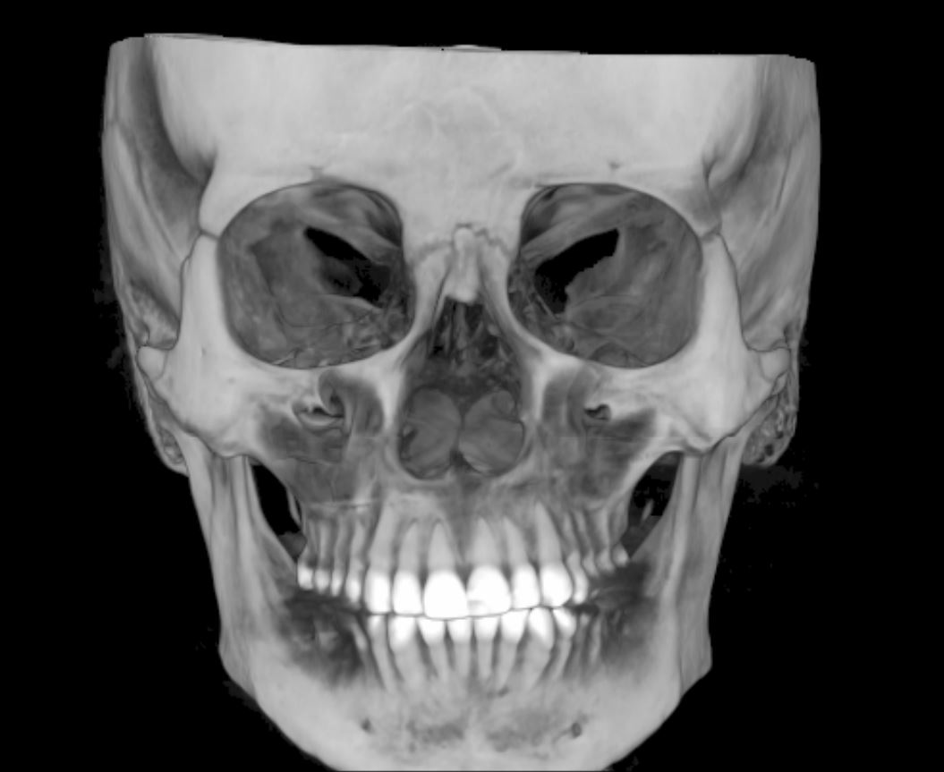 комп'ютерна томографія